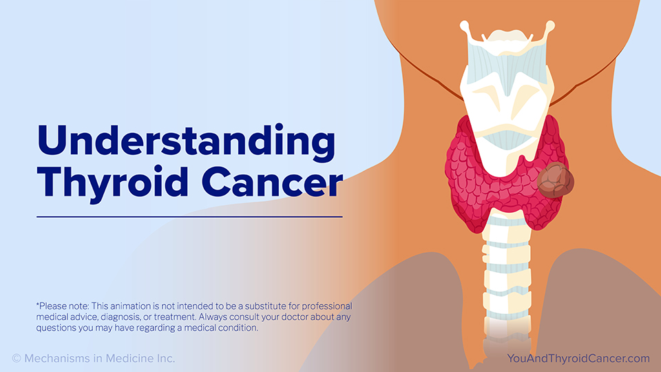 Understanding Thyroid Cancer