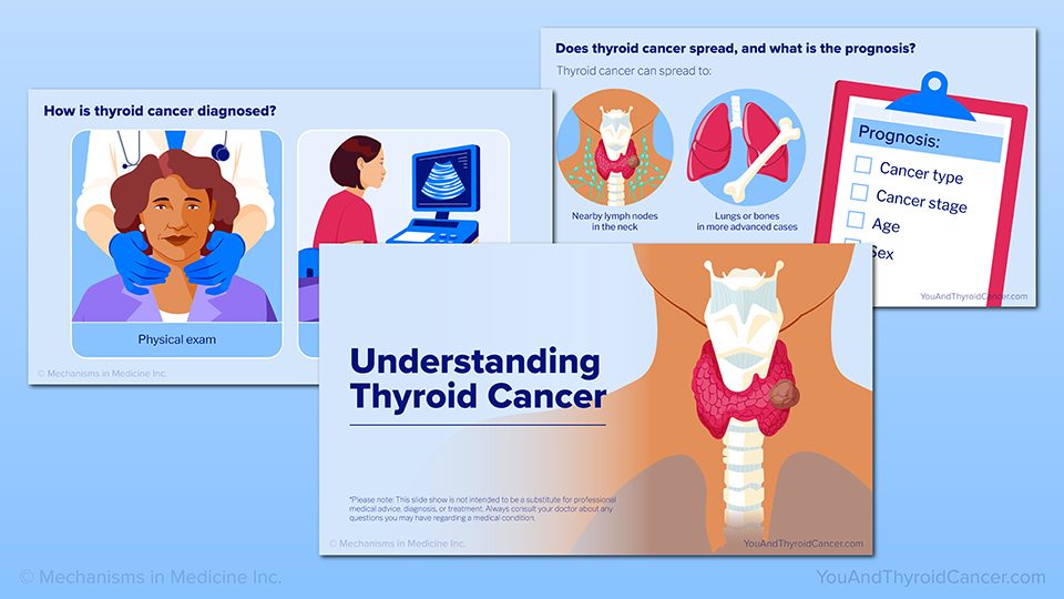 Understanding Thyroid Cancer